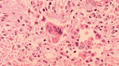 2 measles cases confirmed in Chicago area, one involving O'Hare Airport