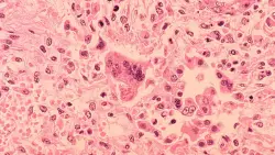 2 measles cases confirmed in Chicago area, one involving O'Hare Airport